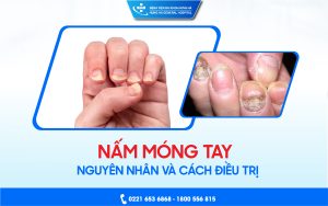Nấm móng tay: Nguyên nhân và cách điều trị tại Bệnh viện đa khoa Hưng Hà