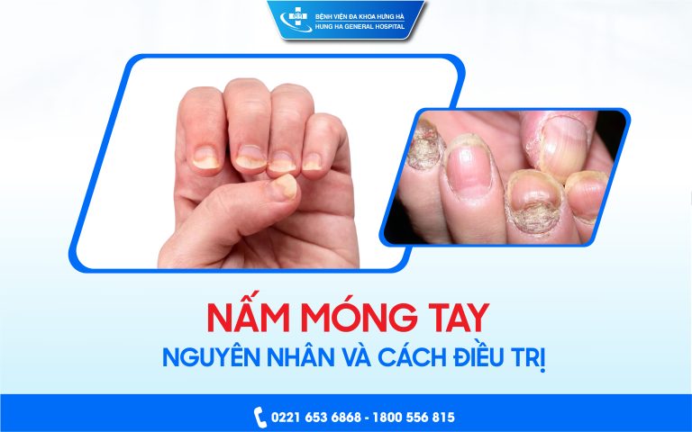 Nấm móng tay: Nguyên nhân và cách điều trị tại Bệnh viện đa khoa Hưng Hà